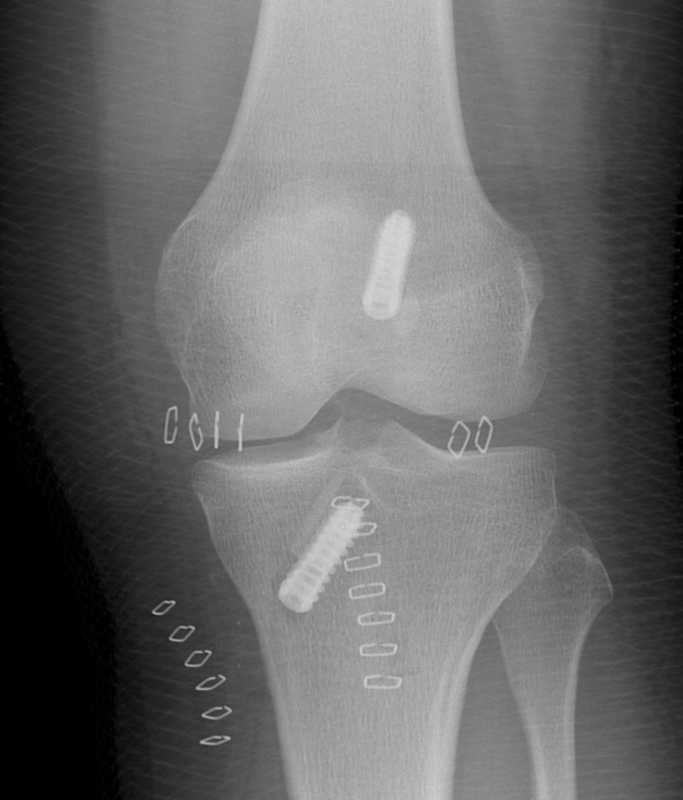 ACL BPTP Autograft AP